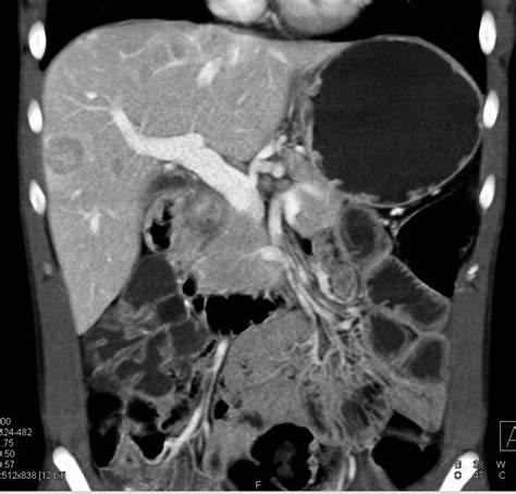 Vascular Liver Metastases From Carcinoid Tumor Liver Case Studies