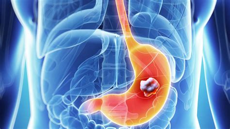 Stomach Cancer Causes Warning Signs And Treatment