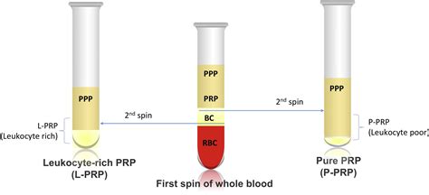 Platelet Rich Plasma And Its Utility In The Treatment Of Acne Scars A