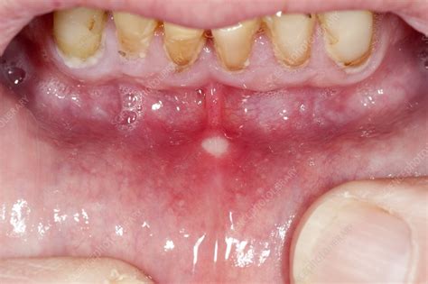 Mouth Ulcers