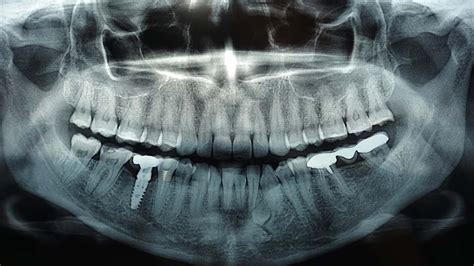 Are Dental X Rays Safe