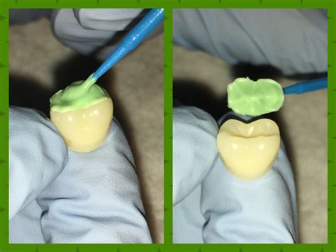 Occlusal Topography Made Simple With A Stamp Mouthing Off Blog Of