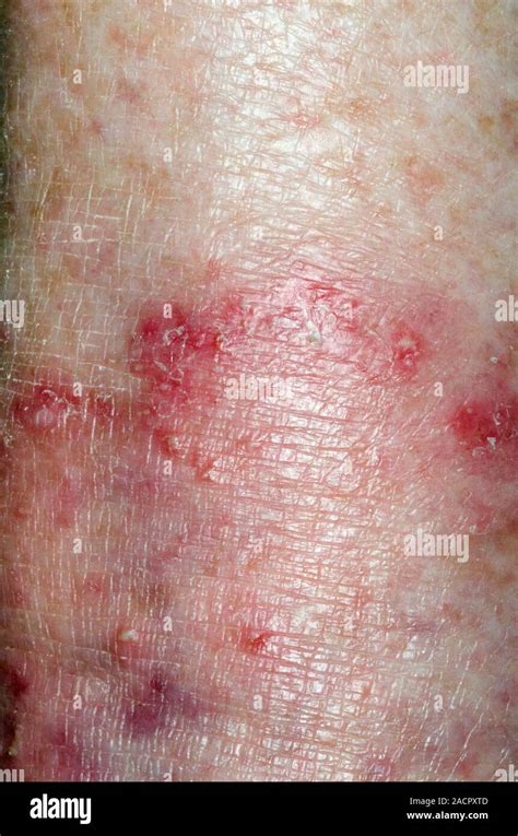 Close Up Of A Red Rash On The Skin Of An 89 Year Old Male Patient Due