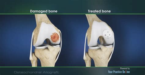 Osteochondral Allograft Michigan Knee Institute