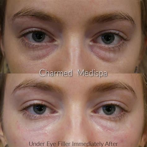 Under Eye Transformation With Filler Charmed Medispa