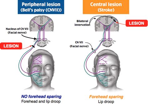 Many studies support the use of corticosteroids and eye care to improve the symptoms of bell's palsy 5 6. Peripheral Lesion (Bell's Palsy) vs. Central Lesion ...