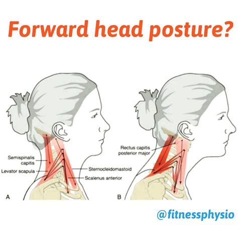 FORWARD HEAD POSTURE . Forward head posture is often related to a