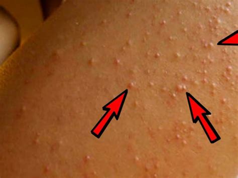 Keratosis Pilaris A Dermatologist Shares Everything You Need To Know