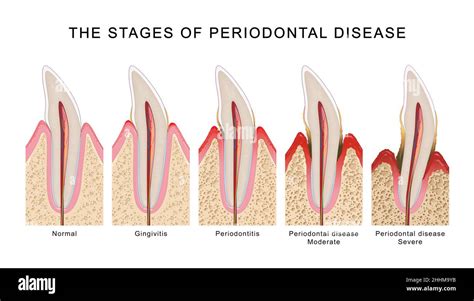 The Stages Of Periodontal Disease Stock Photo Alamy
