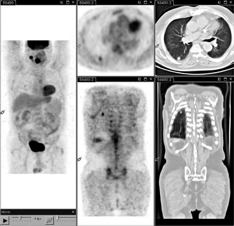 18 F Fdg Pet Ct Performed At Staging In A Patient With Laryngeal