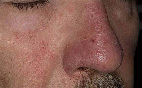 Seborrheic Dermatitis Around Nose