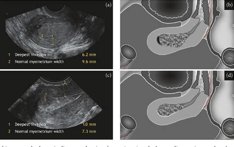 36 Uterine Cancer Ultrasound Images