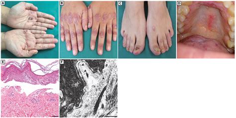 Epidermolysis Bullosa Eb Acquisita In An Adult Patient With
