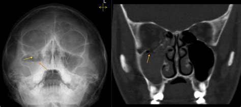 Orbital Blowout Fracture Radiology At St Vincents University Hospital
