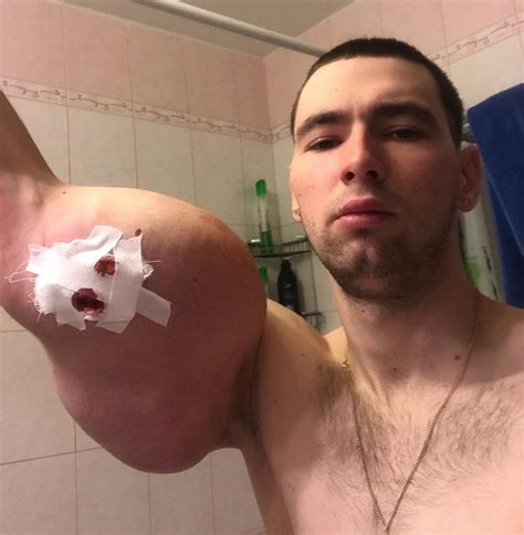 Mma Bodybuilder Popeye Shows Off His Arm After Gruesome Surgery To Have His Rotting Oil Filled