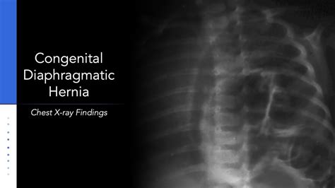 Congenital Diaphragmatic Hernia Explanation Of Chest X Ray Findings