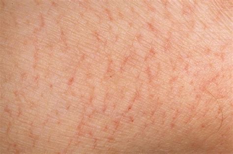 Eczema Dry Skin Dorothee Padraig South West Skin Health Care