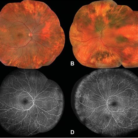 Montaged Ultra Widefield Color Fundus Photograph Of The Right A And