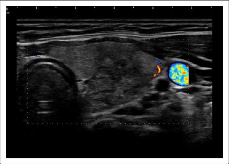 Thyroid Ultrasonography Usg And Doppler Reveled Enlarged Thyroid