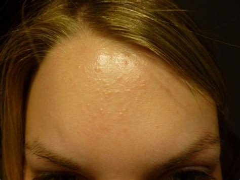 Small White Bump On Face Not Acne Treatment Red Blisters On Childs