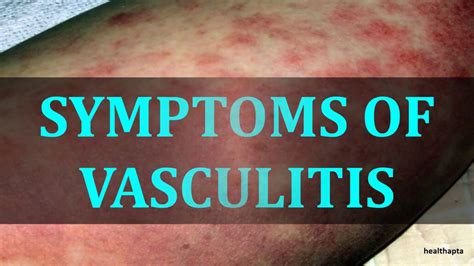 SYMPTOMS OF VASCULITIS YouTube