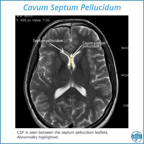 Neuroanatomy Glossary Cavum Septum Pellucidum