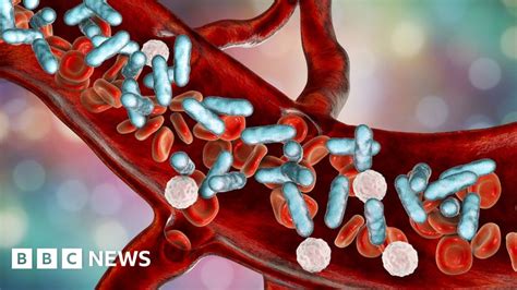 Sepsis Digital Alert Led To Faster Treatment With Antibiotics Bbc News