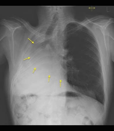 Pneumonectomy With Compensatory Hyperinflation Radiology At St