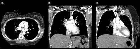 Right Atrial Myxoma Presenting As A Pulmonary Embolism In A 32 Year Old
