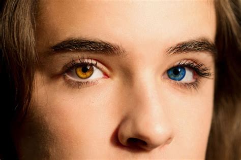 Heterocromía Del Iris Ojos De Diferente Color Tipos Y Causas
