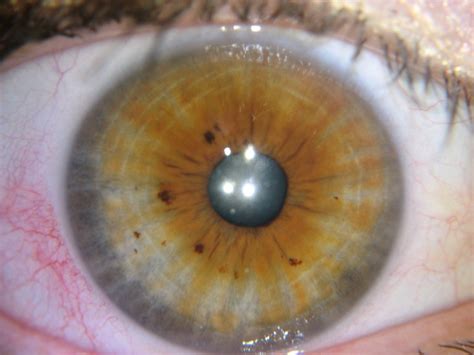 Iridology Spots In Eyes Iriscope Iridology Camera Iriscope Camera