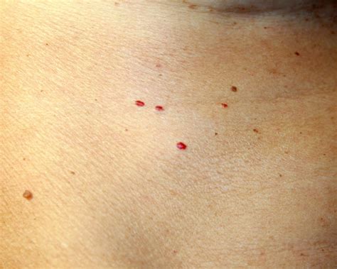 A Quick Way To Get Rid Of Cherry Angiomas Red Moles At Home