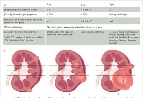 Figure 4 From Contemporary Management Of Small Renal Tumors Semantic