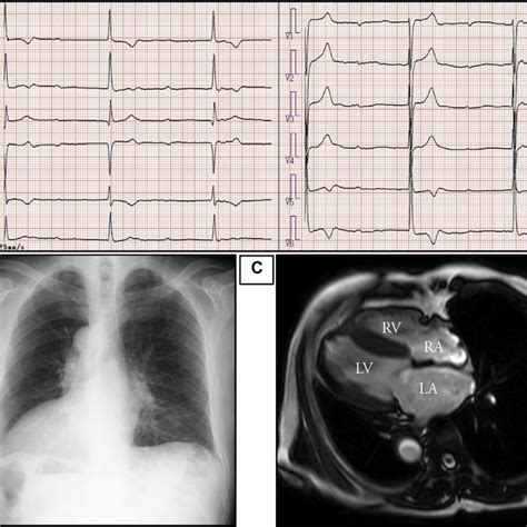 Ct Scan Of The Thorax Showing Dextrocardia And Bronchiectasis Of The