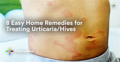 8 Easy Home Remedies For Treating Urticariahives Positivemed