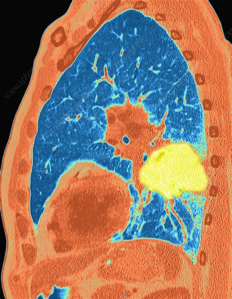 Lung Cancer Ct Scan Stock Image C0187152 Science Photo Library