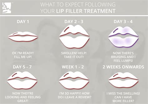 How Long Before You Start To Notice Lip Filler Going Away Plasticsurgery