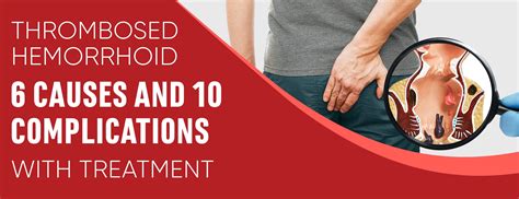 Thrombosed Hemorrhoid 6 Causes And 10 Complications Dr Numb®