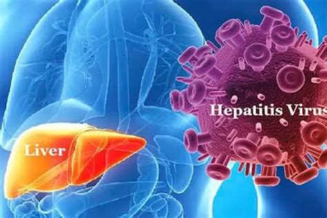 Hepatitis Akut Kenali Gejala Penanganan Dan Cara Mencegahnya Akurat