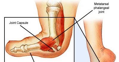 Turf toe is a sprain of the mtp joint at the base of the big toe. The Foot and Ankle Tribune: Turf the "Turf Toe" Injury