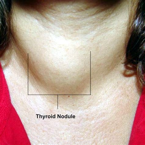 Thyroid Nodules Biopsy Thyroid Nodules Pinterest