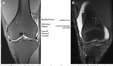 Figure 5 From Normal Mr Imaging Anatomy Of The Knee Semantic Scholar
