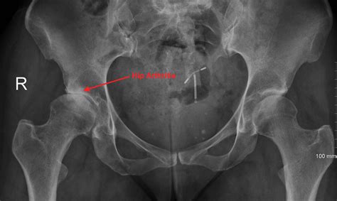 Hip Joint Arthritis