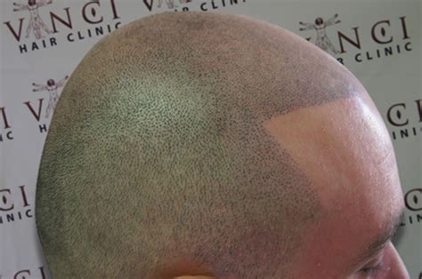 Experienced leading scalp micropigmentation technicians. Going bald in Glasgow? Get a hair tattoo | Evening Times