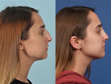 Rhinoplasty Before And After 14