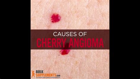 Rubi, mancha de morgan or mancha de campbell de. Cherry Angioma - cherry angioma removal - cherry angioma causes - YouTube