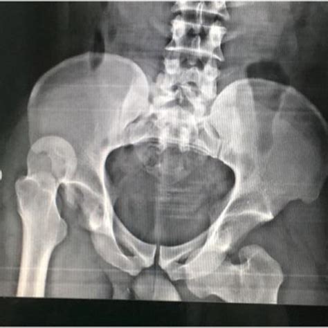 A X Rays Showing Asymmetric Hip Dislocation Right Posterior Superior