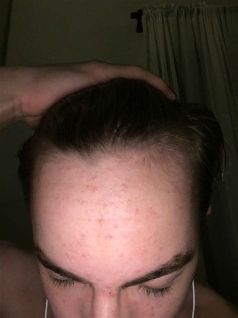 I’m Only 16 Is My Hairline Receding R Hair
