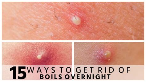 The Boil Is A Skin Infection That Begins In An Oil Gland Or Hair