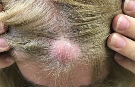 Sebaceous Cyst Scalp Hair Loss Does Hair Grow Back On Stitches I Had
